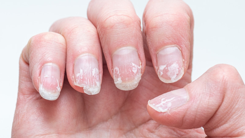 Why Your Nails Break and Peel: Top Causes and Solutions Why Your Nails Break and Peel: Top Causes and Solutions