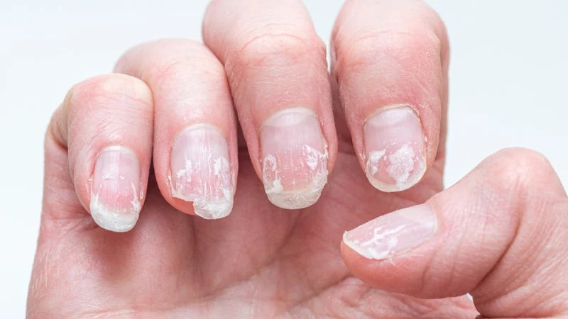 Why Your Nails Break and Peel: Top Causes and Solutions