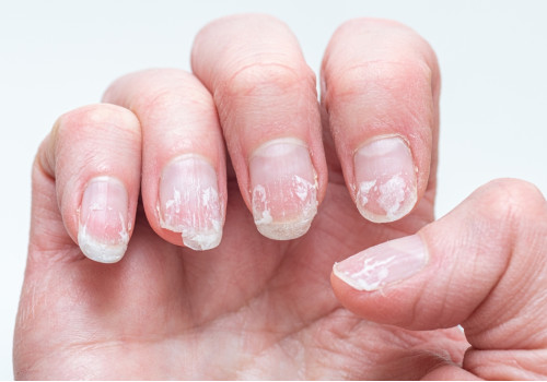 Why Your Nails Break and Peel: Top Causes and Solutions