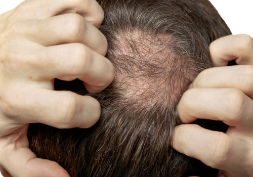 The Link Between Stress and Hair Loss: How to Break the Cycle